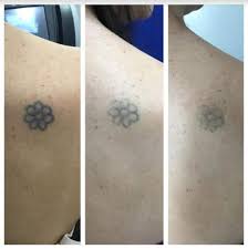 According to a harris interactive poll conducted in january 2012, 1 in 8 an effective and safe way to remove tattoos is through laser surgery, performed by a dermatologist according to the american academy of dermatology, the procedure requires multiple treatments. Picosure Laser Tattoo Removal Treatment In Fairfield Ct