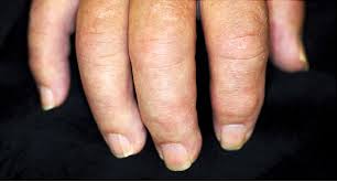 What Psoriatic Arthritis Does To Your Body Explained