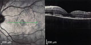 Gass initially suggested that inflammation of the retinal pigment epithelium. Acute Posterior Multifocal Placoid Pigment Epitheliopathy Apmppe Sciencedirect