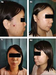 Facial abscess from unlicensed thread lift.