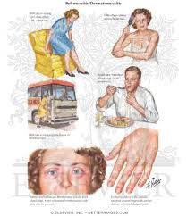 Image result for Polymyositis