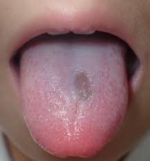 Image result for brown tongue symptoms