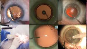 Image result for Cataract Extraction