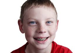 The fundamental difference between braces and veneers is that braces can correct the i had the choice to make between invisalign and traditional braces. Can You Eat Pizza When You Have Braces Wexler Blog