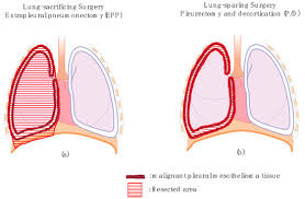 Maybe you would like to learn more about one of these? Jcm Free Full Text Should Lung Sparing Surgery Be The Standard Procedure For Malignant Pleural Mesothelioma Html