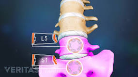 Image result for what is the treatment for l 5 l 5