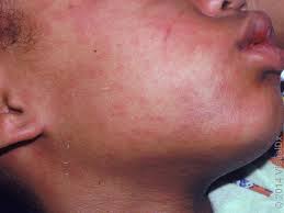 Image result for Rubella