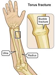 We did not find results for: Buckle Fracture Causes Symptoms Diagnosis Treatment