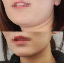 My colleagues seem to particularly love masseter botox (sometimes referred to as jaw botox, since the masseter muscle is attached there), a treatment with twofold results. Botox Injections And Fillers Before And After Id Hospital
