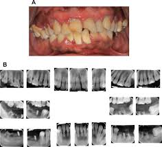 Download 2,237 gingivitis images and stock photos. Evidence Based Update On Diagnosis And Management Of Gingivitis And Periodontitis Dental Clinics