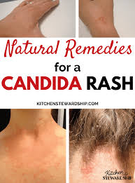 Maybe you would like to learn more about one of these? Candida Symptoms Naturopath Vs M D About The Surprise Rash