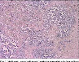 Epidemiology malignant mesothelioma originating from the . Extremely Rare Tumour Malignant Mesothelioma Of Tunica Vaginalis Testis Semantic Scholar