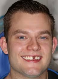 Ugly Dental Implants