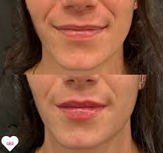 Improve Lip Shape: Enhancing Symmetry and Fullness