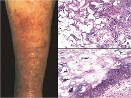 Image result for Panniculitis