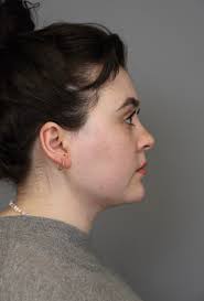 Women under 30 opting for major plastic surgery, alarming experts