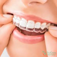 For many, a lack of funds or dental health insurance may affect a decision to straighten teeth. How To Straighten Your Teeth 3 Proven And Safe Methods Trucare Dentistry Roswell