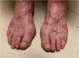 Image result for Koilonychia feet
