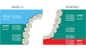 Bicon Dental Implants Surgical Manual Implant Size Selection