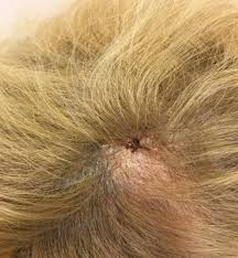 Lichen planopilaris typically presents as smooth white patches of scalp hair loss. It Is Not Invisible A Case Report Of 2 Patients With Scalp Lichen Planopilaris Mimicking Androgenic Alopecia
