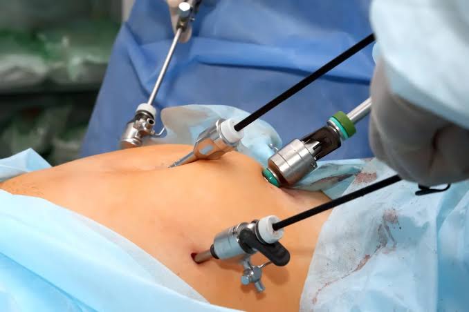 Recurrent and Ectopic Leiomyoma After Hysterectomy: The Critical Need for Cautious Laparoscopic Practice