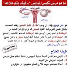 تكيس المبايض والكلوميد هل تحاولين الإنجاب بيبي سنتر آرابيا
