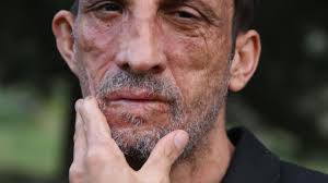 UŞAK'LI AHMET KAYA'NIN YÜZÜ NAKLEDİLEN UĞUR ACAR'DAN ORGAN BAĞIŞI TAVSİYESİ 