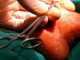 A vasectomia é a cirurgia recomendada para homens que não querem mais ter filhos. Sobre La Vasectomia Gabinete De Urologia Y Andrologia