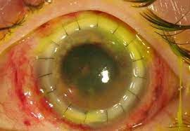 Nos casos assintomáticos não há necessidade de tratamento pois o parasita não apresenta virulência. Um Parasita Comeu O Olho De Uma Garota E Quase A Deixou Cega Flash News