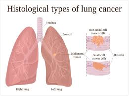 This classification is based on the type of cells in which cancer primarily starts. What Are The Differences Between Small Cell And Non Small Cell Lung Cancer