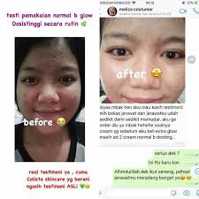 Reaksi awal pemakaian theraskin acne. Paket Acne Untuk Wajah Berjerawat Colistaskincare Shopee Indonesia