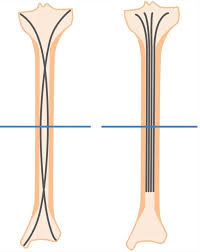 The aim of this review is to summarize the available animal models for evaluating long bone regeneration in vivo. Osteoplasty On Long Bone Diaphyses Undergoing Bending Stress European Radiology Experimental