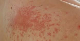 Iritatia apare pe ambele parti ale corpului, iar nu de putine ori se intampla, insa, ca in urma unei zile perfecte de balaceala, oamenii sa se aleaga cu diverse pete, bubite sau iritatii pe piele. O OmidÄƒ Pe Piele Cum IÈ›i Poate Afecta SÄƒnÄƒtatea Pielii