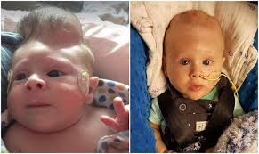 Bebê com cérebro fora do crânio sobrevive a cirurgia reparatória