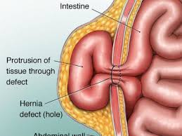 Paradoxically, the larger ones often hurt less, the reason being that a large 'window' in the abdominal wall that allows the. The 4 Types Of Hernias Medicalopedia