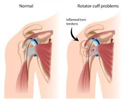 How To Heal Shoulder And Lumbar Spine Injuries Rotator Cuff Surgery Shoulder Impingement Syndrome Rotator Cuff