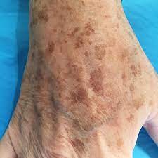 Behandlung Der Altersflecken Lentigo Senilis Lentigo Solaris Dr Med Martin Zoppelt Zurich