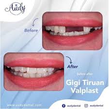 We did not find results for: Gigi Tiruan Lepasan Audy Dental