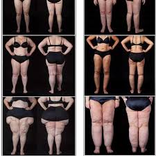 Benim Lipodem Hikayem Kadinlar Kulubu