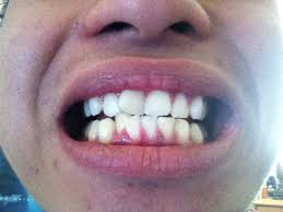 But if you're looking to correct gapped teeth, your options range from if it is due to a malposition of the teeth, then dental aligners can fix a small gap by applying orthodontic forces on both teeth that are adjacent to the gap to create bodily. Straighten Teeth Without Braces Reddit Teethwalls