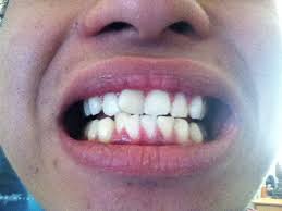 Fix the gap between teeth through using of dental bonding. Teeth Shifted After Braces Reddit Teethwalls