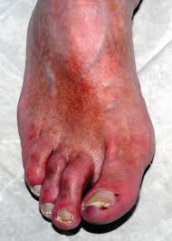 Image result for toe black diabetes