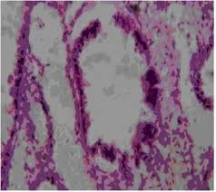 Congenital mirror movement, also known as cmm, is a rare disorder or habit characterized by though it is a syndrome wherein their hands are somewhat restricted to move independently, their. Pdf Microcystic Congenital Pulmonary Airway Malformation Of The Lung Causing Non Immune Hydrops Fetalis And Mirror Syndrome A Case Report Semantic Scholar