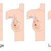 A detailed look at breast cancer did you know there are 15 types of breast cancer? 1