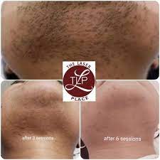 You can kiss all those nasty razors and waxes goodbye! Queens Laser And Electrolysis Hair Removal 30 Photos 77 Reviews Laser Hair Removal 87 08 Justice Ave Elmhurst Ny United States Phone Number Yelp
