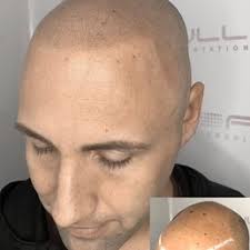 FULL MICROPIGMENTATION