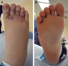A lisfranc joint injury is a type of injury to the bones or ligaments in the middle part of your foot, the tarsometatarsal joint. Lisfranc Injury And Jones Fracture In Sports Clinics In Podiatric Medicine And Surgery
