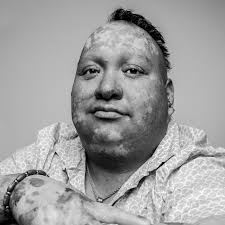 🅰️: The life expectancy of someone with #EpidermolysisBullosa varies  greatly depending