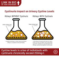 Cystine Kidney Stones The Nastiest Of All With Images Kidney Stones