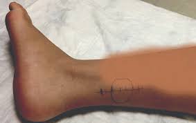 Learn about symptoms, prevention, and treatment. Diagnosing A Painful Mass With A Genetic Component Podiatry Today